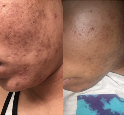 NxN Vitamin C & Hyaluronic Acid Serum Set